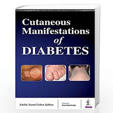 Cutaneous Manifestations Of Diabeties